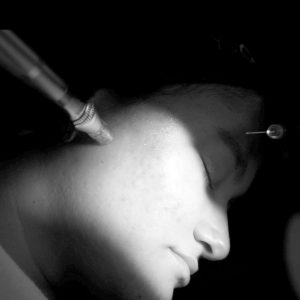 Dermapen (1 sesión)