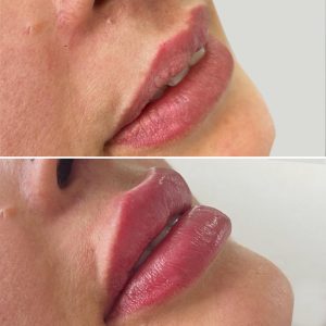 Aumento o perfilado de labios